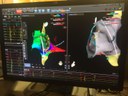 ricostruzione-tridimensionale-di-camera-cardiaca-atriale-per-albazione-di-tachicardia-sopraventricol-lab-elettrofisiologiaare.jpg