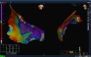 ricostruzione-tridimensionale-di-camera-cardiaca-ventricolare-dall-endo-e-dall-epicardio-lab-elettrofisiologia.jpg